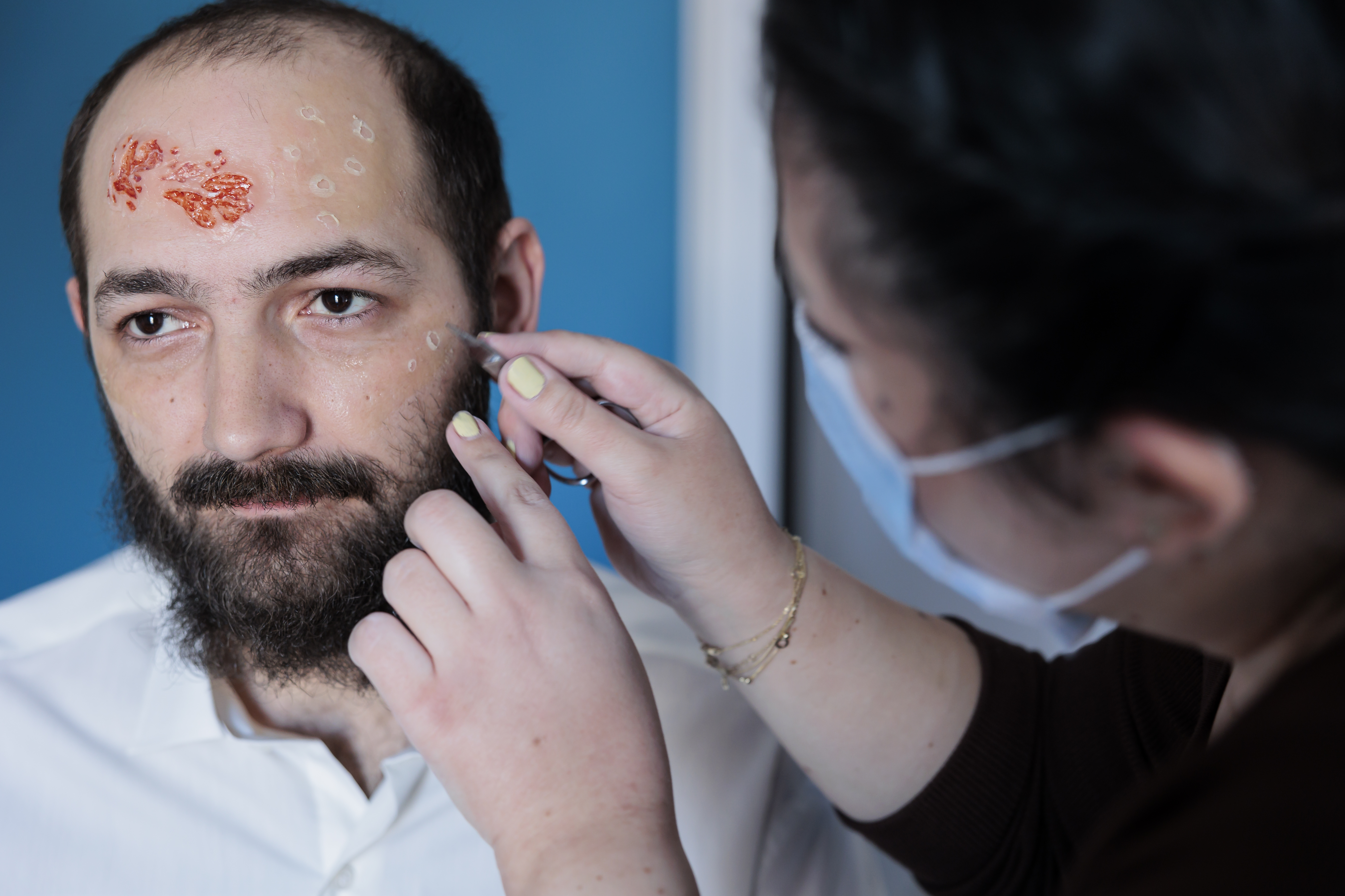 Systemic Lupus Erythematosus